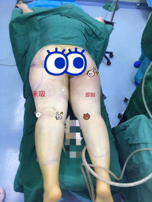 郭昌灏受邀专访：讲述吸脂如何做让脂肪保有活性