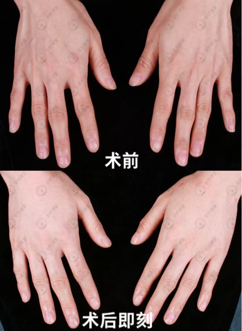 准备好了吗，深圳联合丽格带你揭秘嗨体的真面目