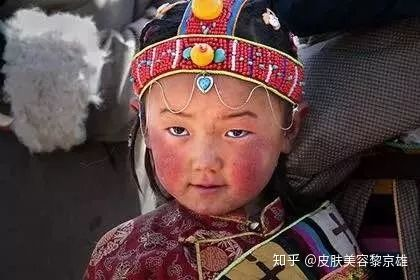 面部红血丝是怎么回事？如何祛除？黎京雄院长带你解密