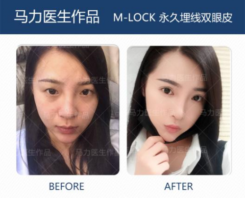 北京爱悦丽格马力：为什么贴双眼皮贴会让眼皮变松弛？