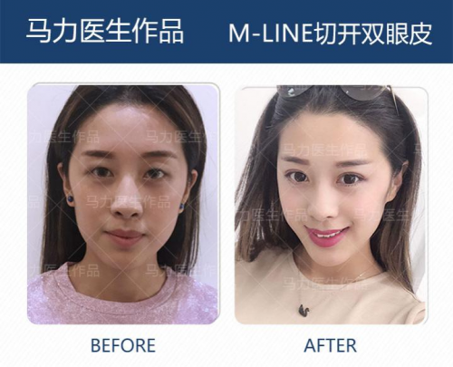 北京爱悦丽格马力：为什么贴双眼皮贴会让眼皮变松弛？