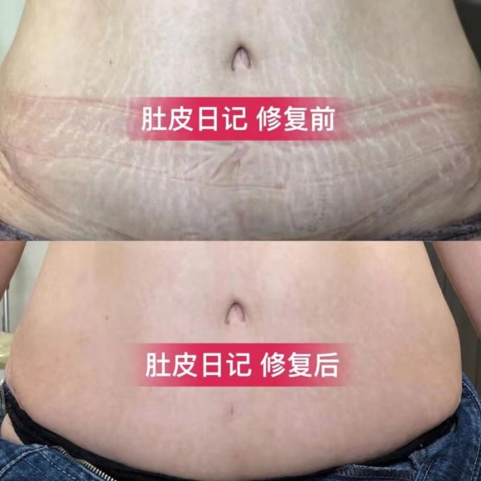 妊娠纹能修复吗？肚皮日记妊娠纹修复培训加盟