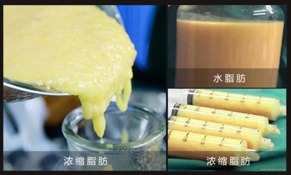 北京艾玛整形韦元强讲解浓缩脂肪丰胸的优势有哪些？