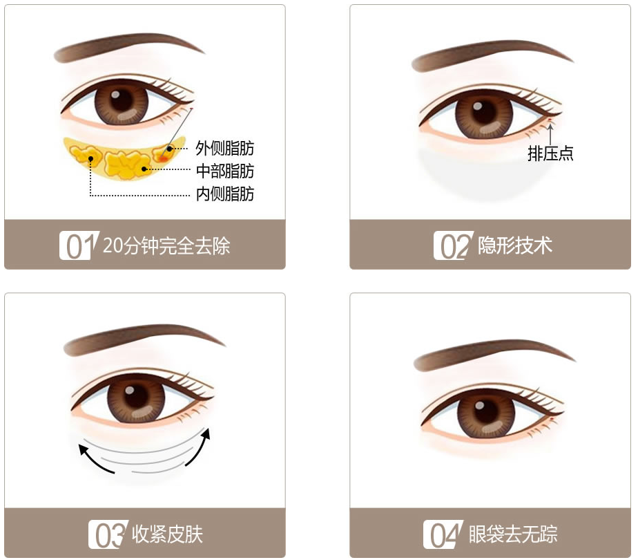 长沙健丽整形美容去眼袋对视力有影响吗?