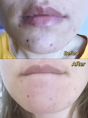 NYMPHARA瑶纯|女儿的青春痘，让我成为我羡慕的那种人