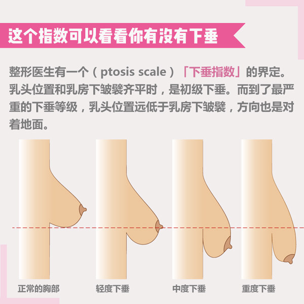 联合丽格第一医疗美容医院杨大平教授：如何判断乳房的松垂程度？