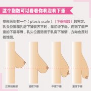 联合丽格第一医疗美容医院杨大平教授：如何判断乳房的松垂程度？